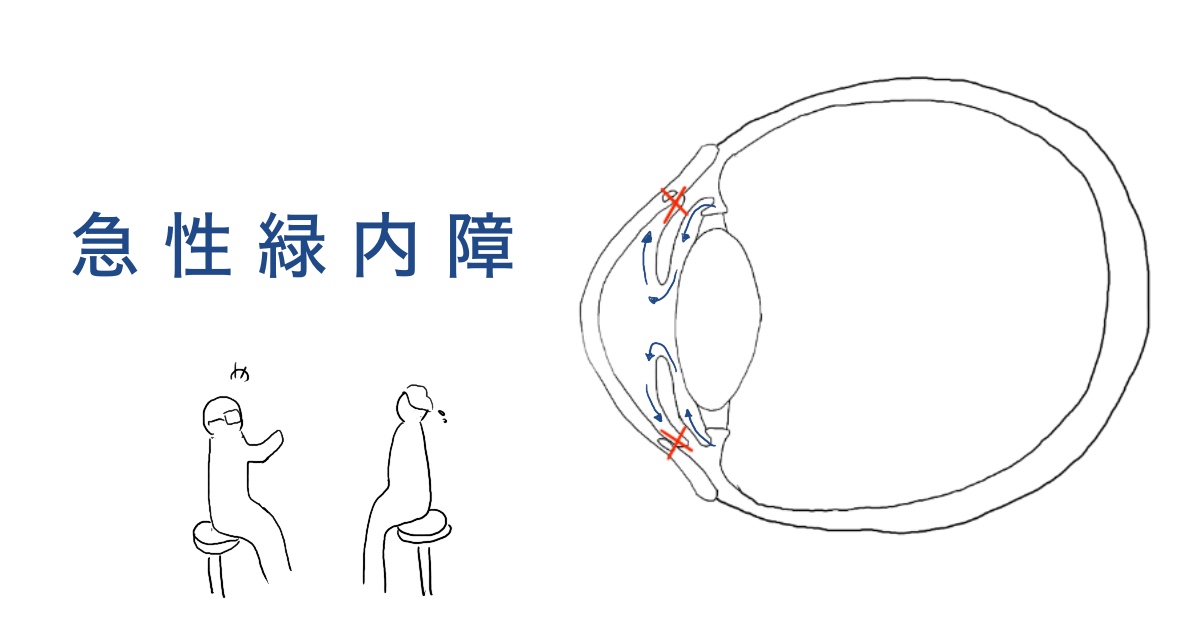 放置すれば失明も…「急性緑内障」と言われて家族で学んだこと